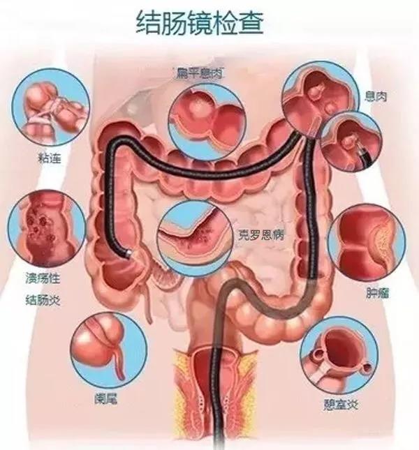 外科阑尾炎临床表现及护理